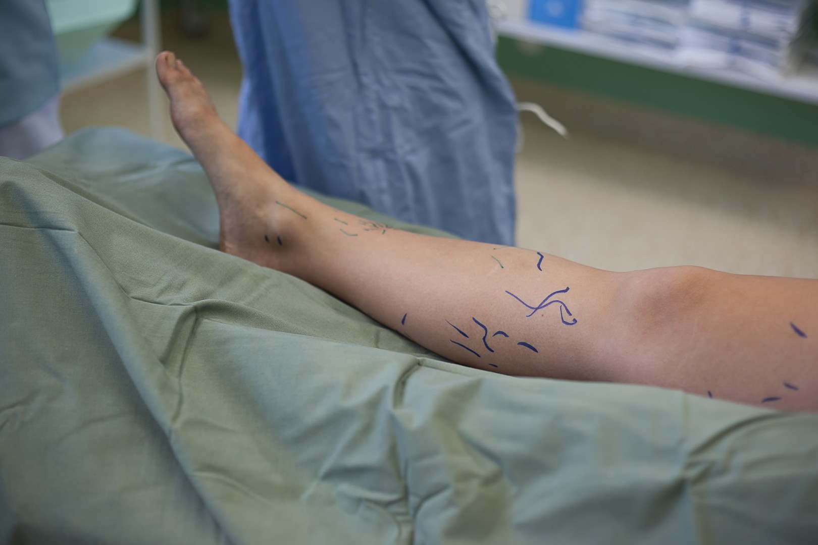 Varicose veins stripping