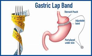 Gastric band fill