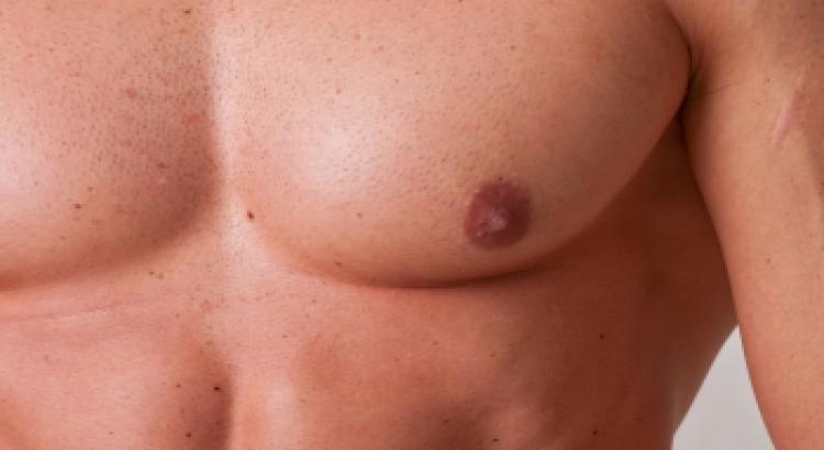 Male chest correction