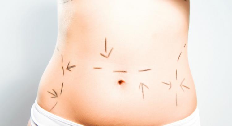 Liposculpture